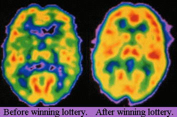 Brain scan of lottery winner.  Before winning lottery. After winning lottery.